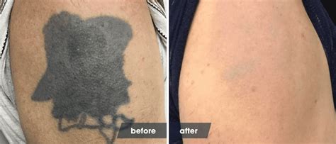laser tattoo removal timeline|healing after laser tattoo removal.
